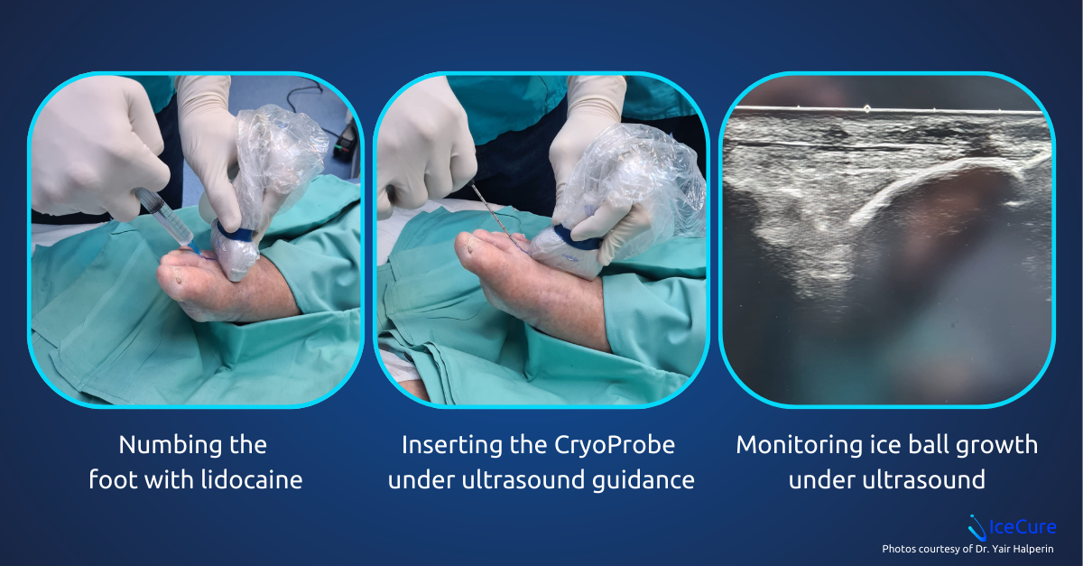 Photo illustration of cryoablation for pain palliation. The foot is numbed with lidocaine. A needle like cryoprobe is inserted under ultrasound guidance. The growth of the ice ball is monitored under ultrasound.